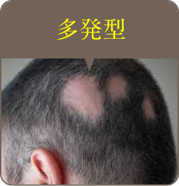 多発型