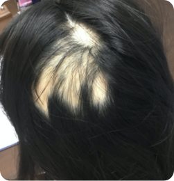 10代女性の事例 Before
