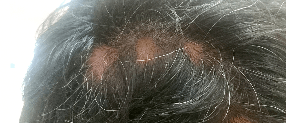 円形脱毛症にも対応